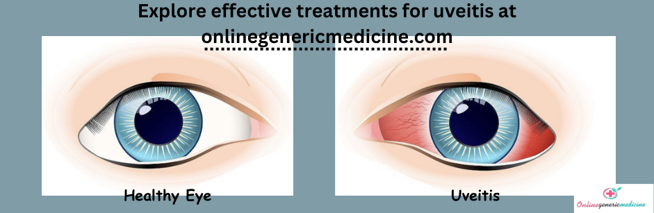 Uveitis Medications Uveitis Medications