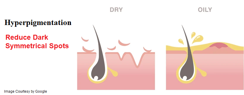 How to Effectively Treat and Prevent Hyperpigmentation: A Complete Guide
