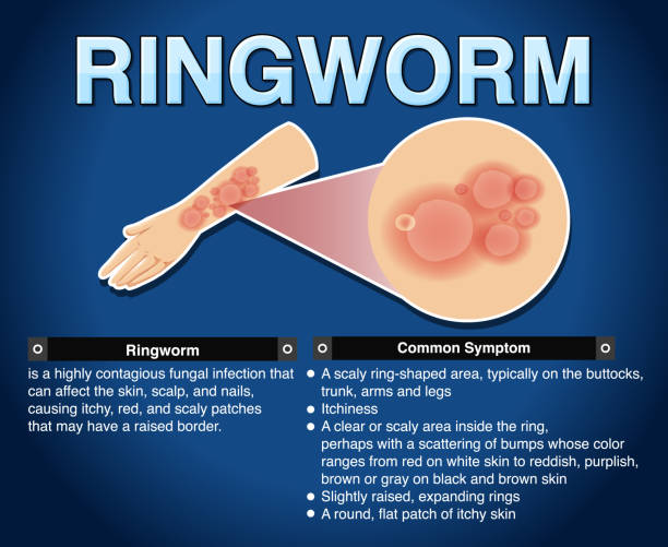 Is it Ringworm Infection? Causes, Signs, Prevention & Treatment
